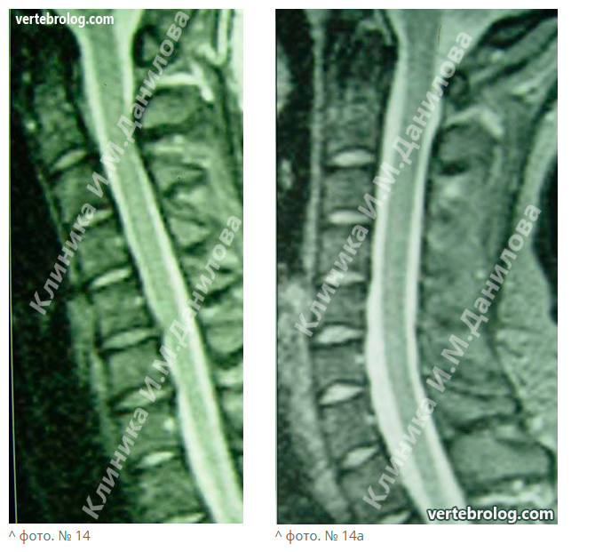 Рецидив грыжи после операции на позвоночнике. Дуральный мешок шейного отдела. Дуральный мешок позвоночника мрт.
