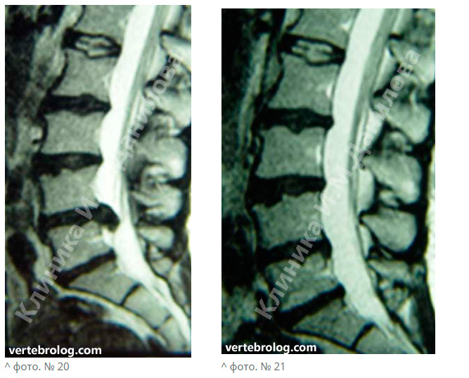 Вертебролог белгород. Секвестрированная грыжа l4-l5. Томография грыжа l4 l5. Мрт после операции на межпозвоночной грыже.