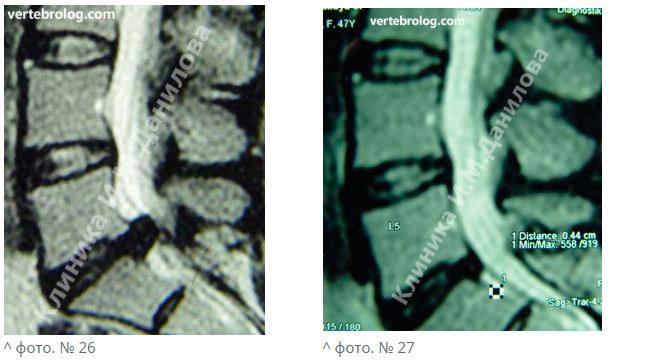Секвестрированная грыжа поясничного отдела позвоночника фото