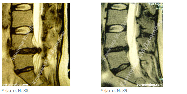 Секвестрированная грыжа поясничного отдела позвоночника фото