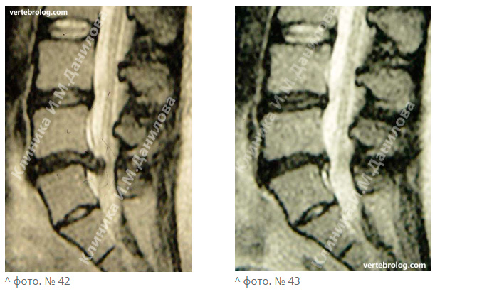 Секвестрированная грыжа поясничного отдела позвоночника фото
