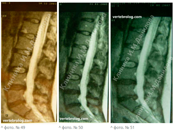 Протрузия поясничного отдела фото