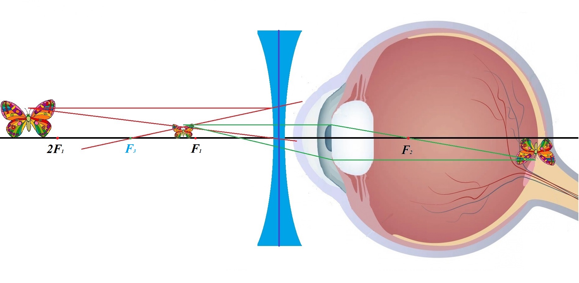На сетчатку глаза за 3 с. Миопия двояковогнутые линзы. Двояковогнутая линза для близорукости. Двояковогнутые линзы при близорукости. Линзы для глаз для зрения дальнозоркость.