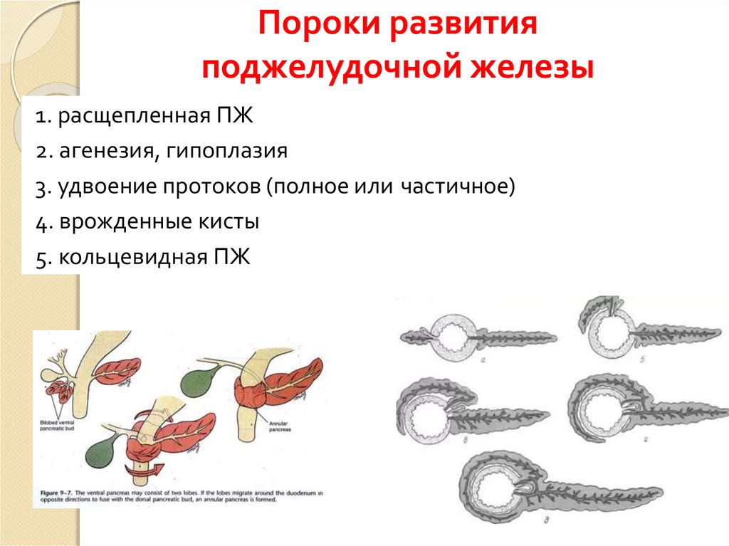 Развитие железа. Аномалии развития поджелудочной железы. Аномалии строения поджелудочной железы. Врожденные аномалии поджелудочной железы. Дефекты развития поджелудочной железы.