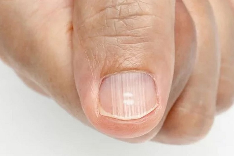 Нехватка кальция на ногтях фото