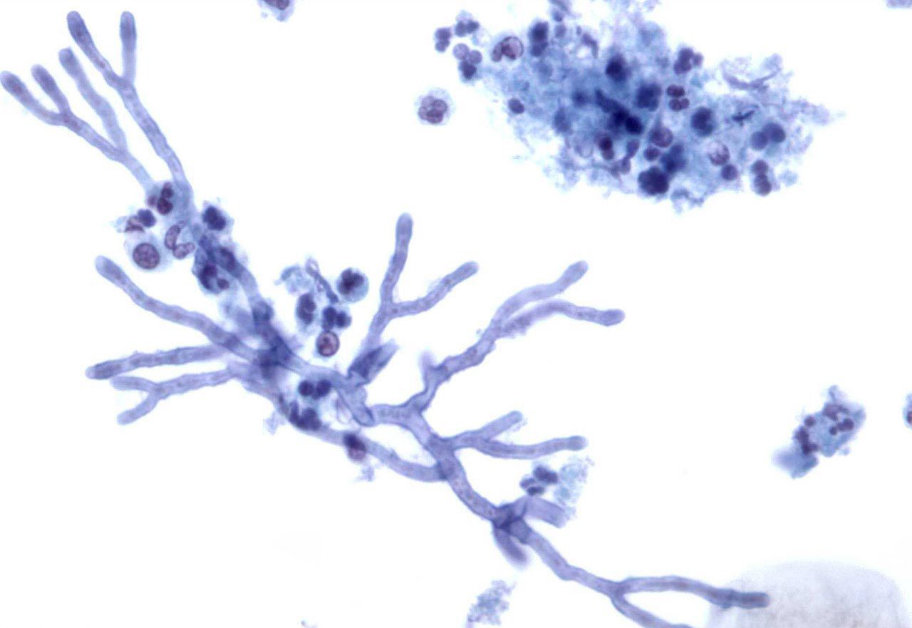 Споры candida. Дрожжеподобные грибы рода Candida. Грибок кандида под микроскопом. Грибы аспергилл кандида. Что такое грибковая инфекция Candida.