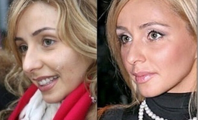 Юлия ковальчук до и после пластики фото